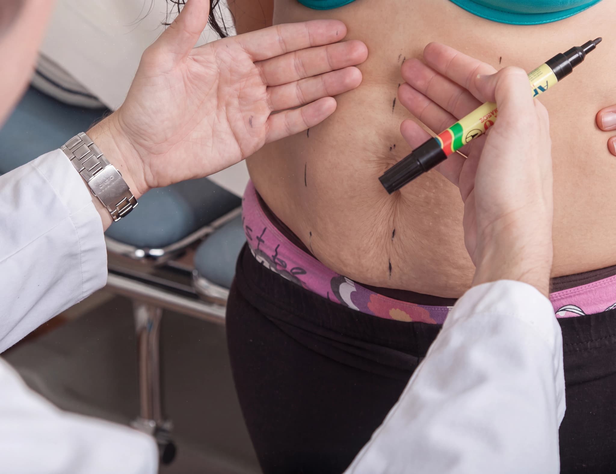 Läkare ritar markeringar på en patients mage med en penna inför ett medicinskt ingrepp.