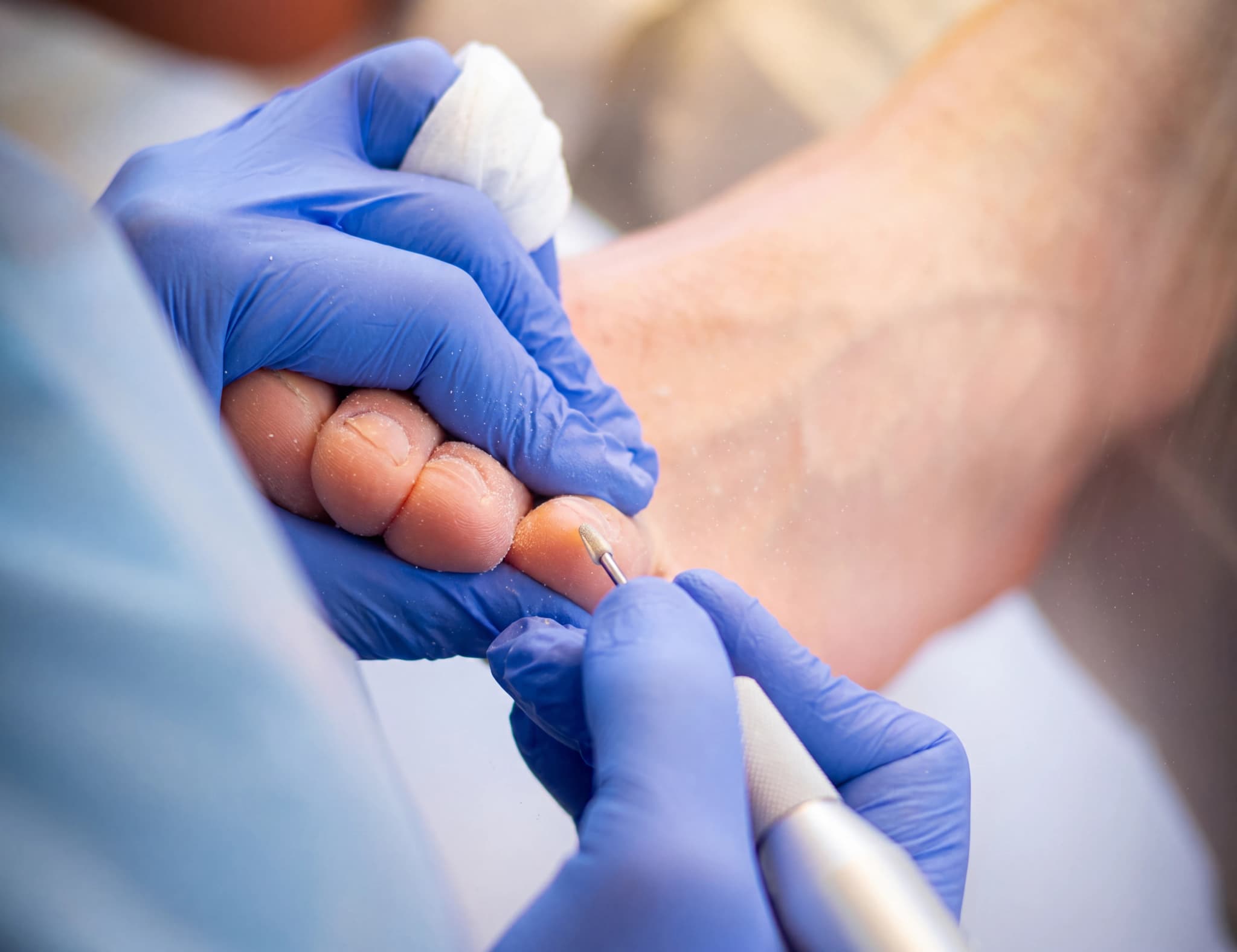 Podiatriker som filar patientens tånaglar med en elektrisk fil i en klinik.