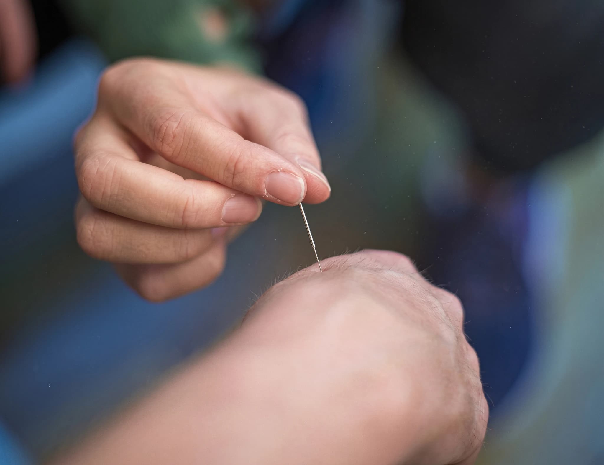 En person applicerar en akupunkturnål på en annan persons hand.
