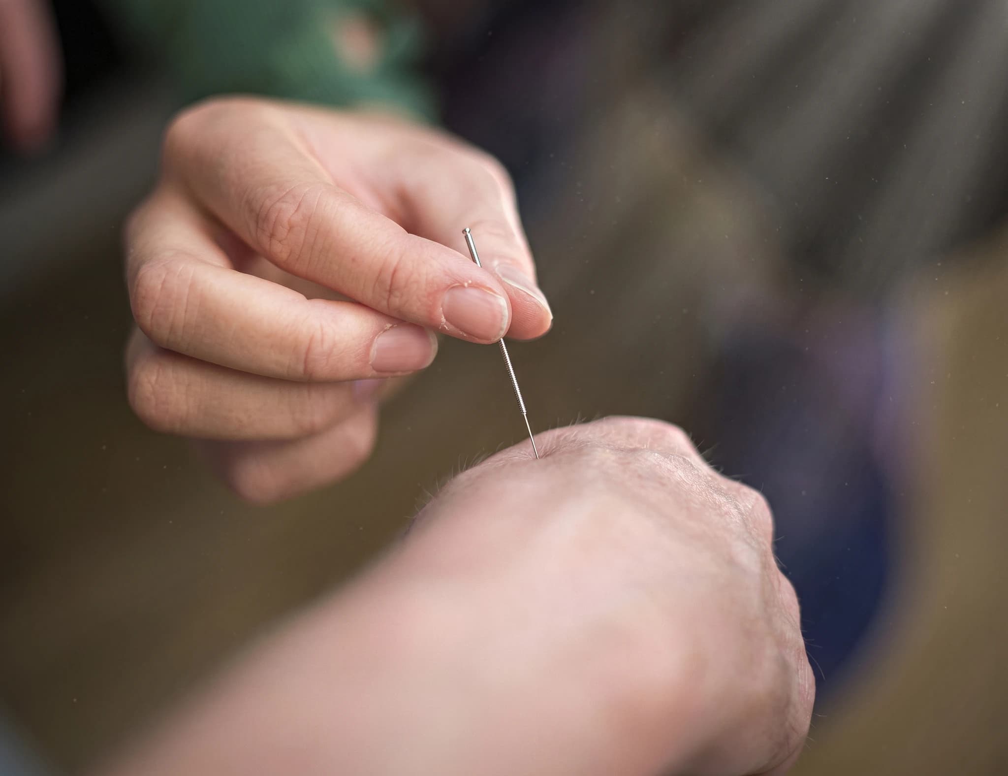 En person håller en akupunkturnål redo att sätta in den i en annan persons hand.