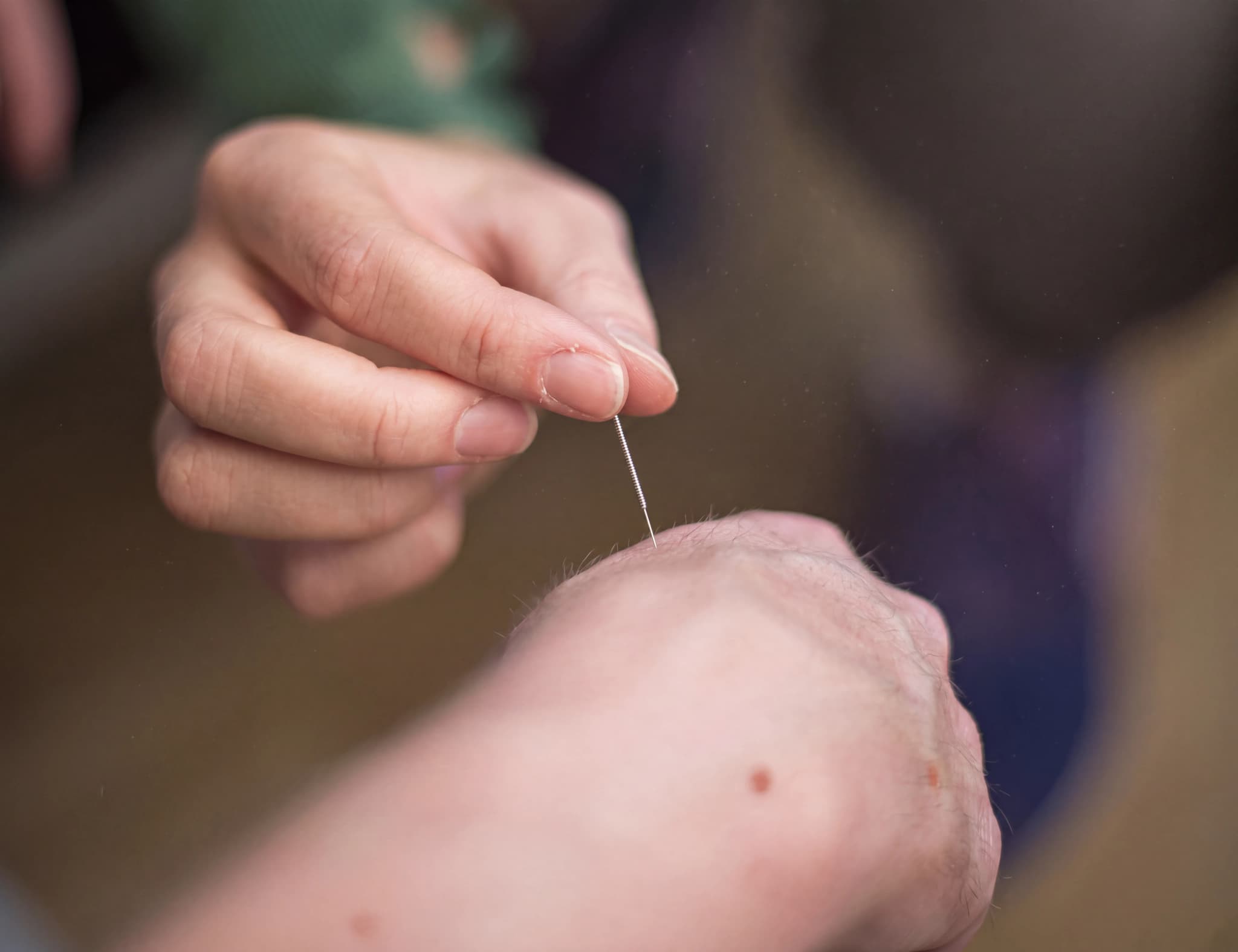 En person använder en akupunkturnål för att behandla en annan persons hand.