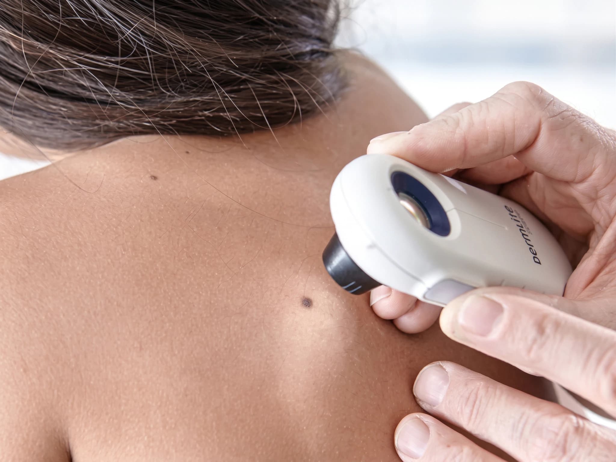 Dermatolog undersöker födelsemärke med dermatoskop.