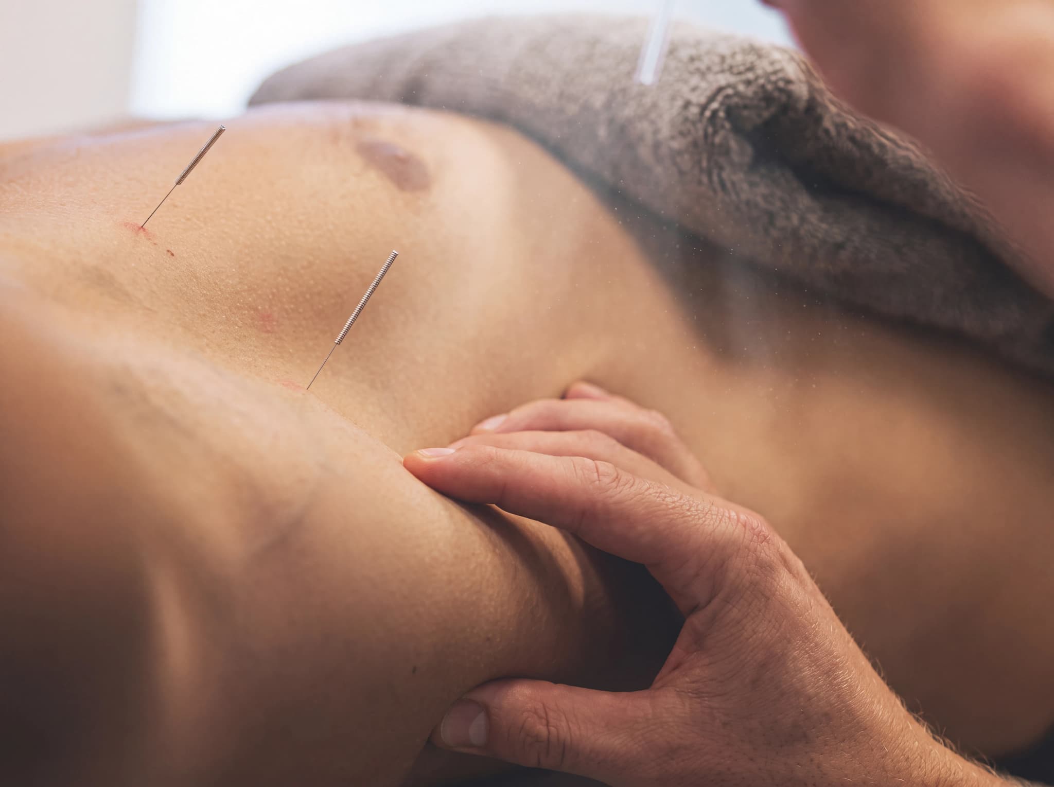 En akupunktör applicerar tunna nålar på en persons torso under en behandling.