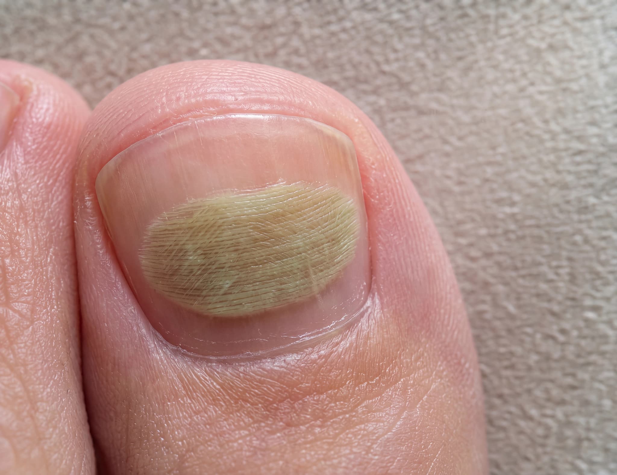 Närbild av en tå med svampinfektion på nageln, som visar missfärgning och förtjockning.