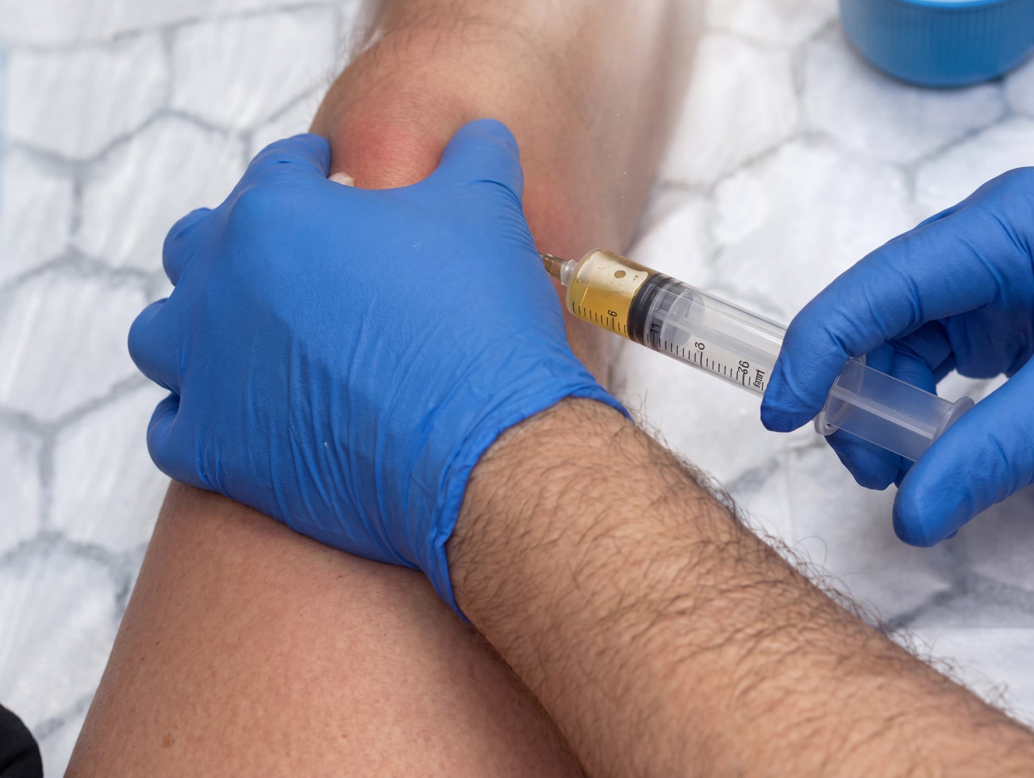 Läkare med blå handskar injicerar blodplasma i en patientens knäled med en spruta.