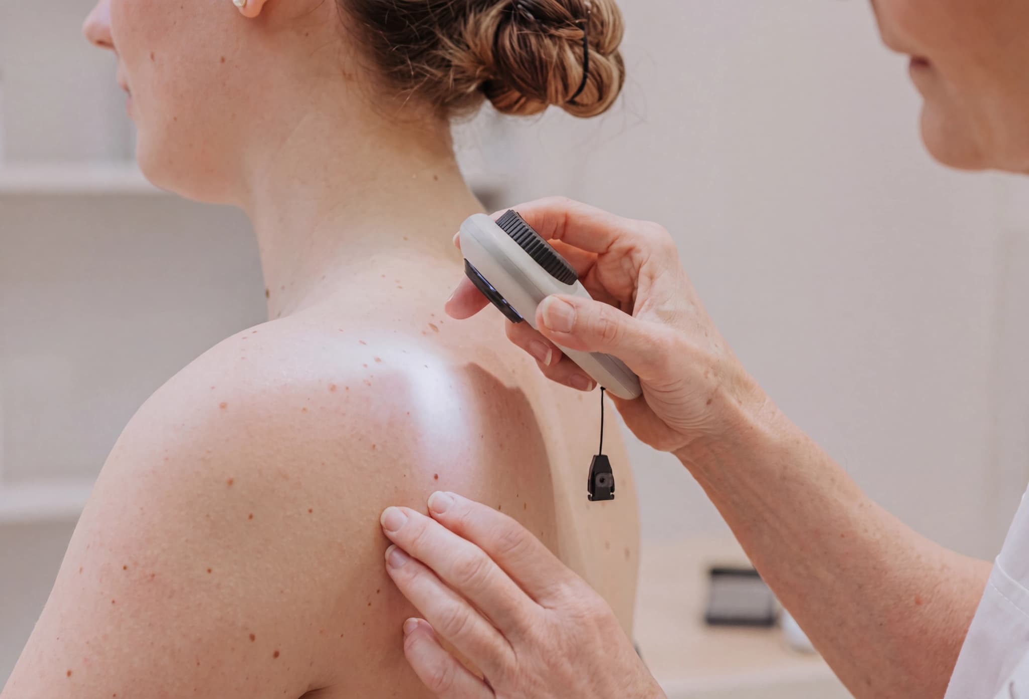 Läkare undersöker hudförändring på en patients axel med en dermatoskop.