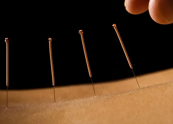 Akupunktur Lund